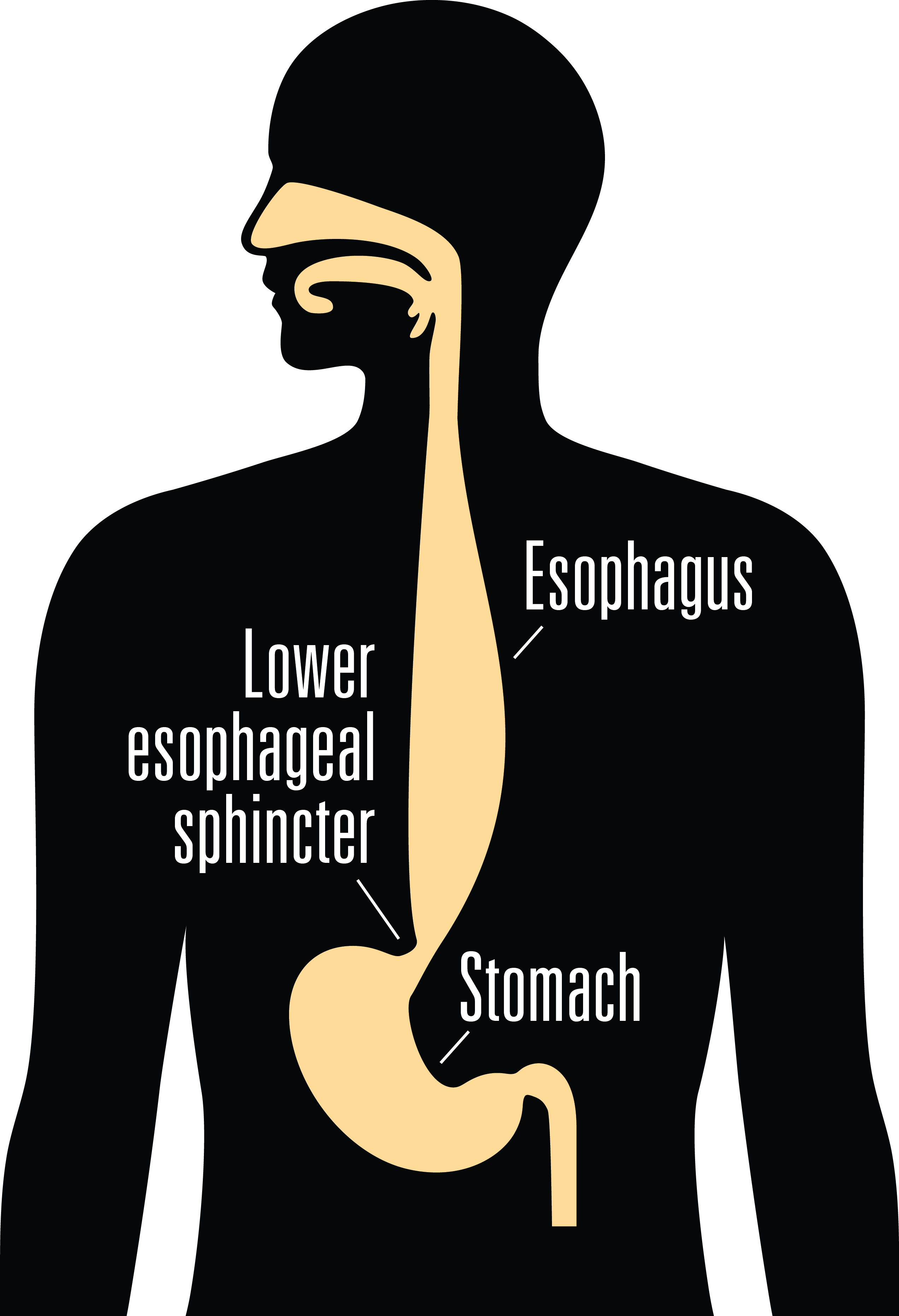Graphic showing the esophagus, lower esophageal sphincter, and the stomach