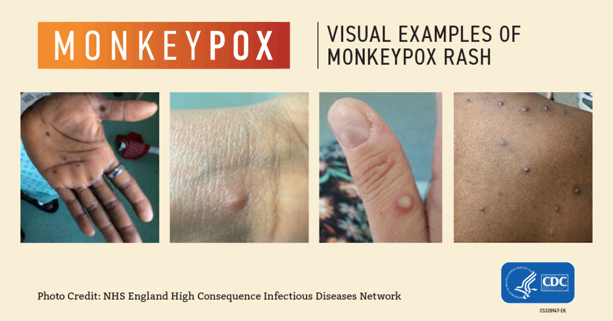 What's monkeypox?' Woman with 'insane rash' turned away for testing