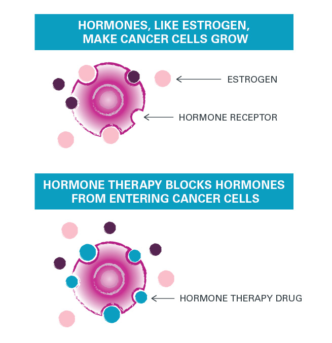 Breast Cancer Study Tests Pairing Hormone Therapy With Immunotherapy 