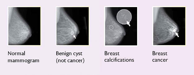 A mammogram can help your provider determine whether your lump is harmless or if more testing is needed. Source: National Cancer Institute