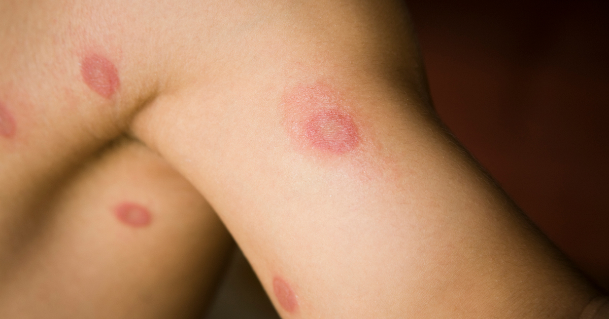 How to know if I have ringworm or eczema - Quora
