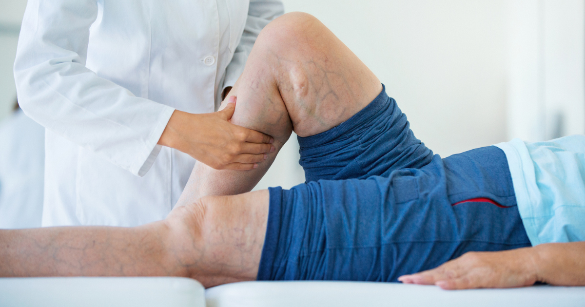 Close up of doctor examining man's legs with varicose veins