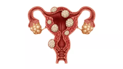 illustration of uterine fibroids