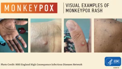 How does monkeypox start? Plus, 5 pictures to show how the bumps progress