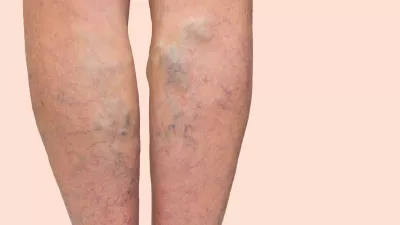 Woman's legs with varicose veins
