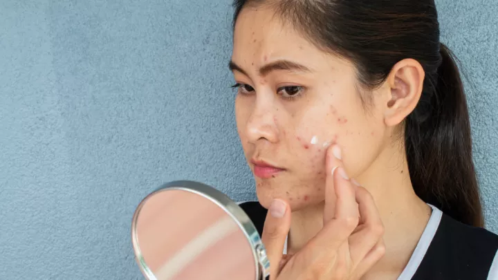 Woman applying acne cream