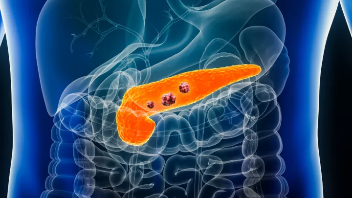 Medical illustration of pancreatic cancer